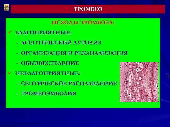 ТРОМБОЗ ИСХОДЫ ТРОМБОЗА: ü БЛАГОПРИЯТНЫЕ: - АСЕПТИЧЕСКИЙ АУТОЛИЗ - ОРГАНИЗАЦИЯ И РЕКАНАЛИЗАЦИЯ - ОБЫЗВЕСТВЛЕНИЕ