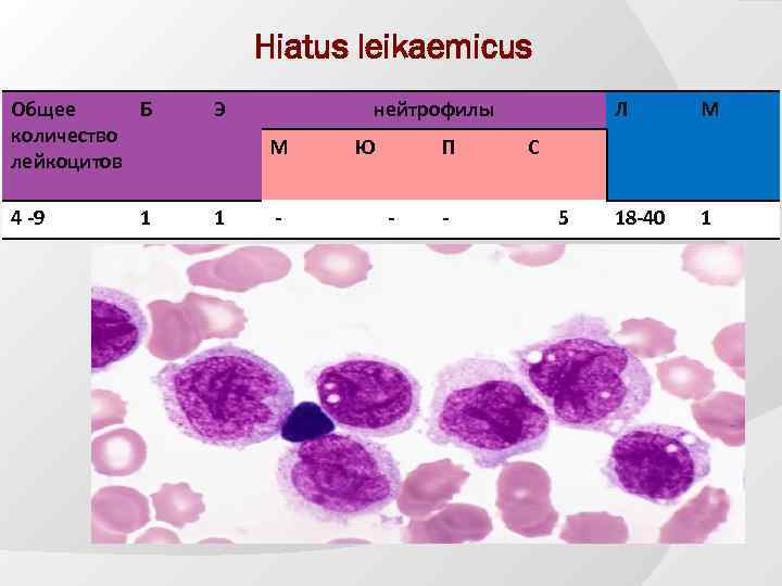 Hiatus leikaemicus Общее Б количество лейкоцитов Э 4 -9 1 1 нейтрофилы М -