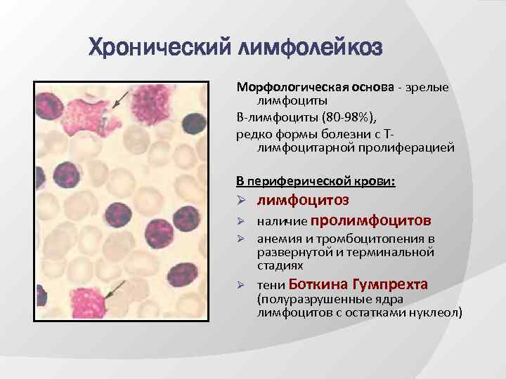 Реакция на лейкоциты положительная. В -лимфоциты хронический лимфолейкоз. Острый лейкоз и хронический лимфолейкоз. Хронические лейкозы миелолейкоз лимфолейкоз. Тени Боткина Гумпрехта.