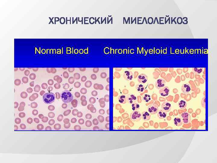 Лейкозы лейкемоидные реакции. Хронический миелолейкоз презентация. Лейкемоидная реакция нейтрофильного типа. Лейкемоидной реакцией миелоидного типа. Этиология лейкемоидных реакций.