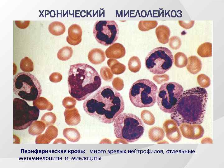 Картина крови при хроническом миелолейкозе