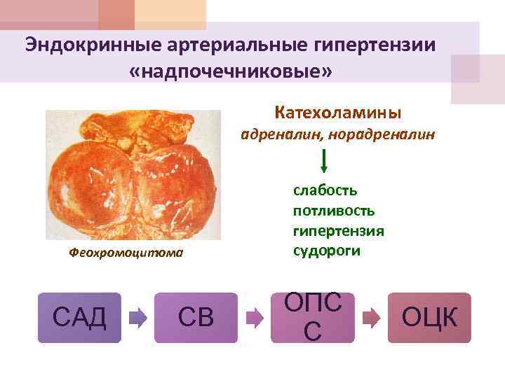 Эндокринные артериальные гипертензии