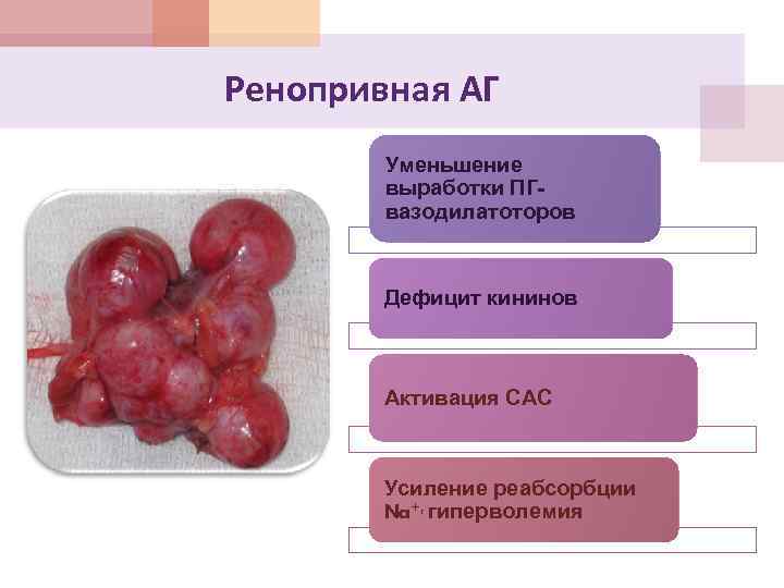 Ренопривная АГ Уменьшение выработки ПГвазодилатоторов Дефицит кининов Активация САС Усиление реабсорбции Na+, гиперволемия 