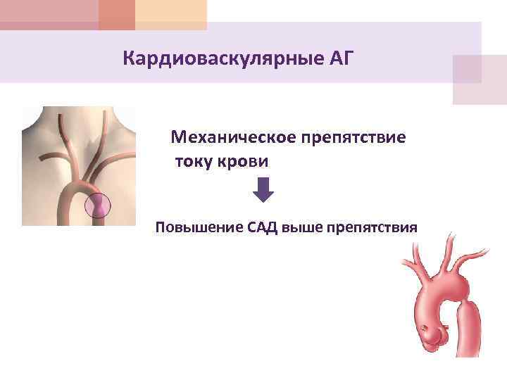 Кардиоваскулярные АГ Механическое препятствие току крови Повышение САД выше препятствия 
