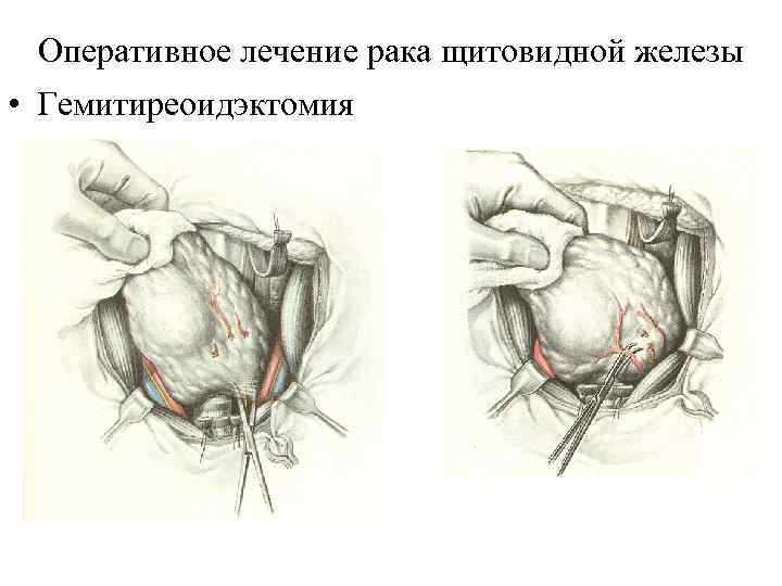 Оперативное лечение рака щитовидной железы • Гемитиреоидэктомия 