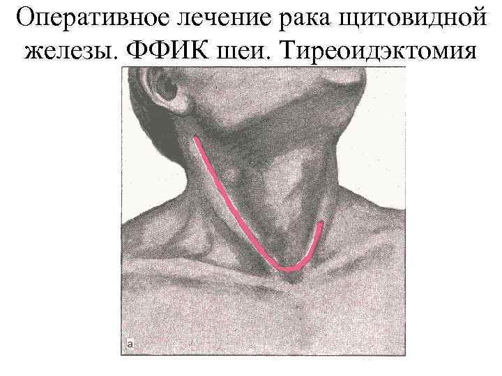 Оперативное лечение рака щитовидной железы. ФФИК шеи. Тиреоидэктомия 