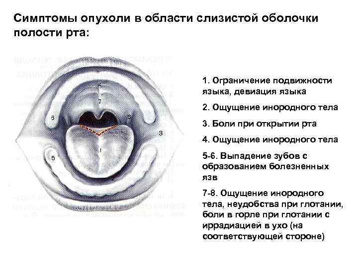 Симптомы опухоли в области слизистой оболочки полости рта: 1. Ограничение подвижности языка, девиация языка