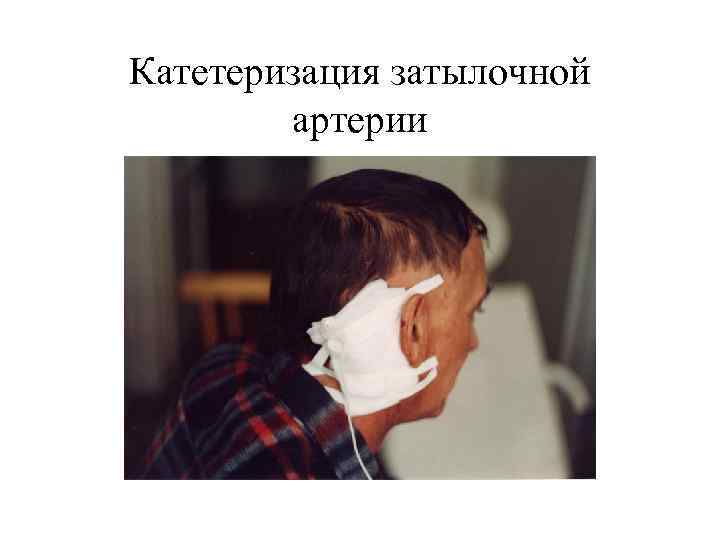 Катетеризация затылочной артерии 