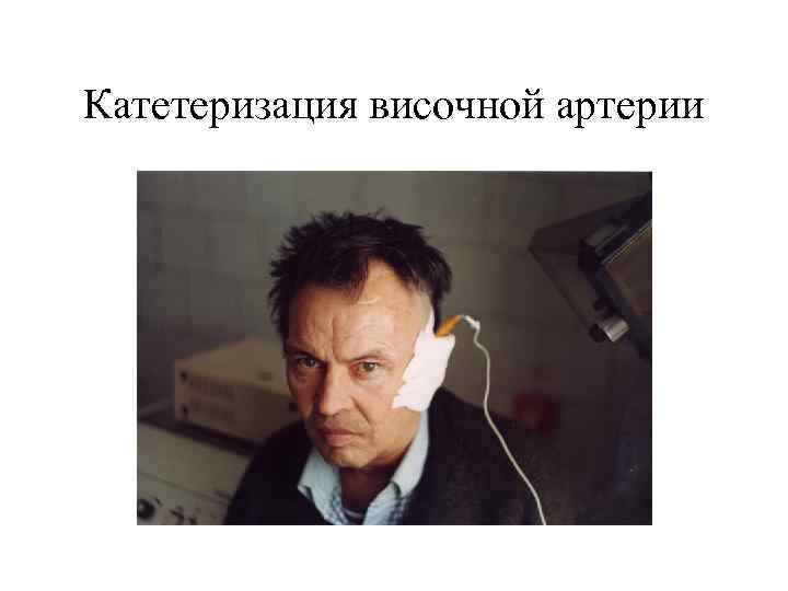 Катетеризация височной артерии 