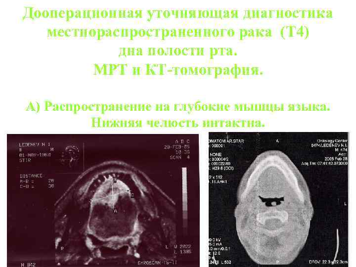 Дооперационная уточняющая диагностика местнораспространенного рака (T 4) дна полости рта. МРТ и КТ-томография. А)