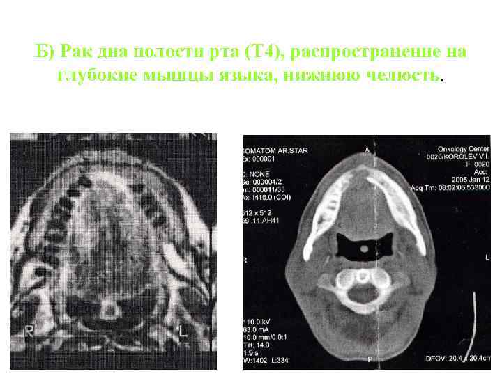 Рак дна полости рта фото начальная стадия