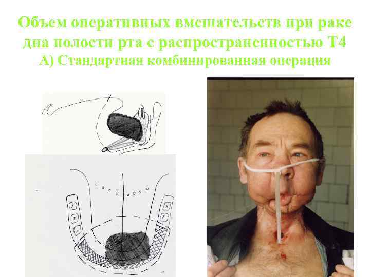 Объем оперативных вмешательств при раке дна полости рта с распространенностью Т 4 А) Стандартная