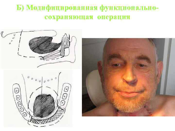 Б) Модифицированная функциональносохраняющая операция 