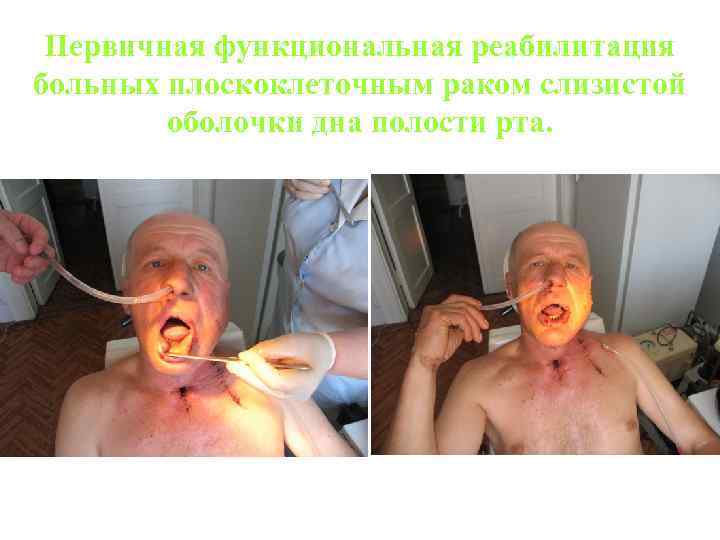 Первичная функциональная реабилитация больных плоскоклеточным раком слизистой оболочки дна полости рта. 