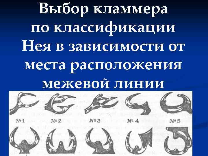 Выбор кламмера по классификации Нея в зависимости от места расположения межевой линии 