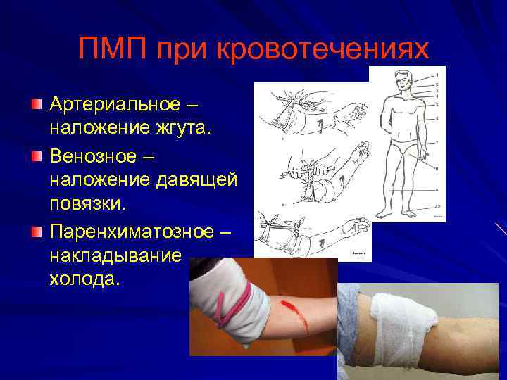 ПМП при кровотечениях Артериальное – наложение жгута. Венозное – наложение давящей повязки. Паренхиматозное –