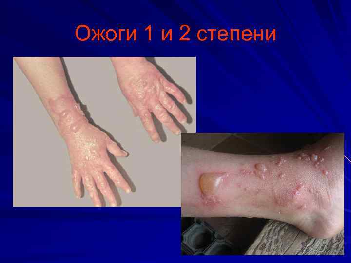 Ожоги 1 и 2 степени 
