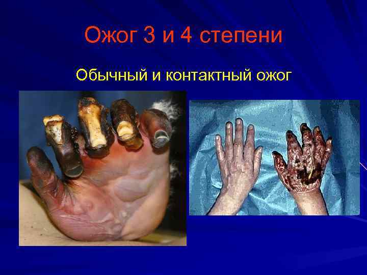 Ожог 3 и 4 степени Обычный и контактный ожог 