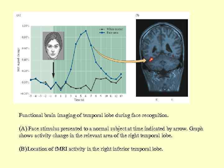 Functional brain imaging of temporal lobe during face recognition. (A) Face stimulus presented to