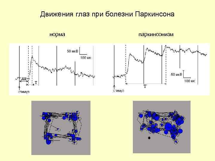 Движения глаз при болезни Паркинсона норма паркинсонизм 