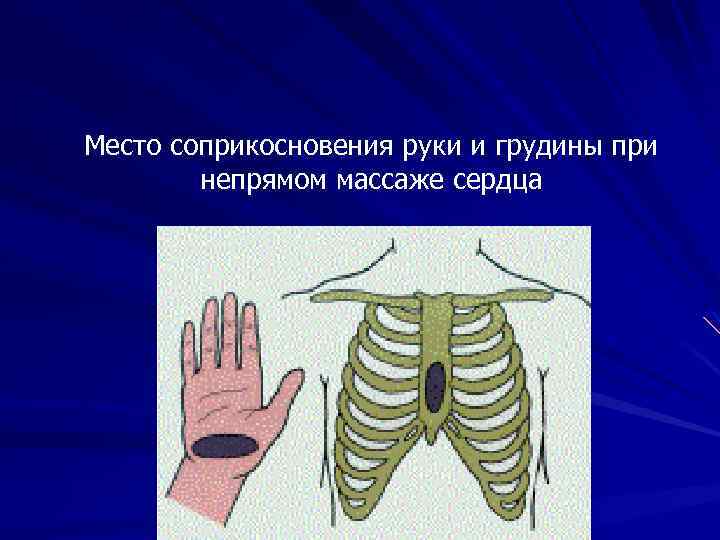 Место соприкосновения руки и грудины при непрямом массаже сердца 