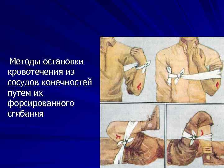 Методы остановки кровотечения из сосудов конечностей путем их форсированного сгибания 