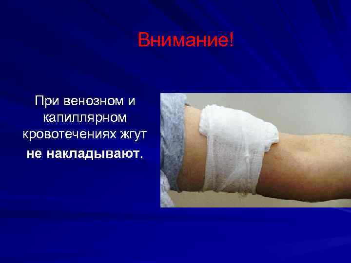 Внимание! При венозном и капиллярном кровотечениях жгут не накладывают. 
