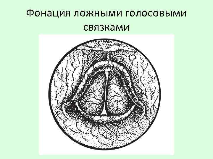 Ложные голосовые связки