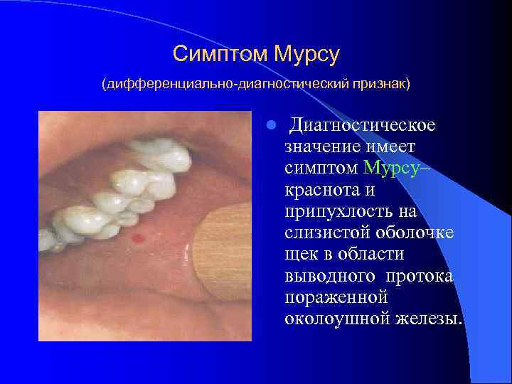Симптом Мурсу (дифференциально-диагностический признак) l Диагностическое значение имеет симптом Мурсу– краснота и припухлость на