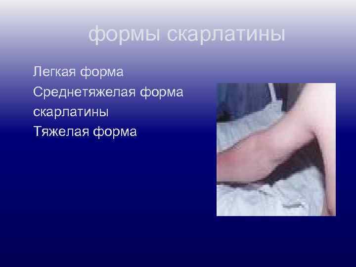  формы скарлатины Легкая форма Среднетяжелая форма скарлатины Тяжелая форма 