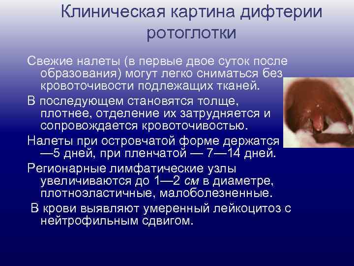 Клиническая картина дифтерии ротоглотки Свежие налеты (в первые двое суток после образования) могут легко