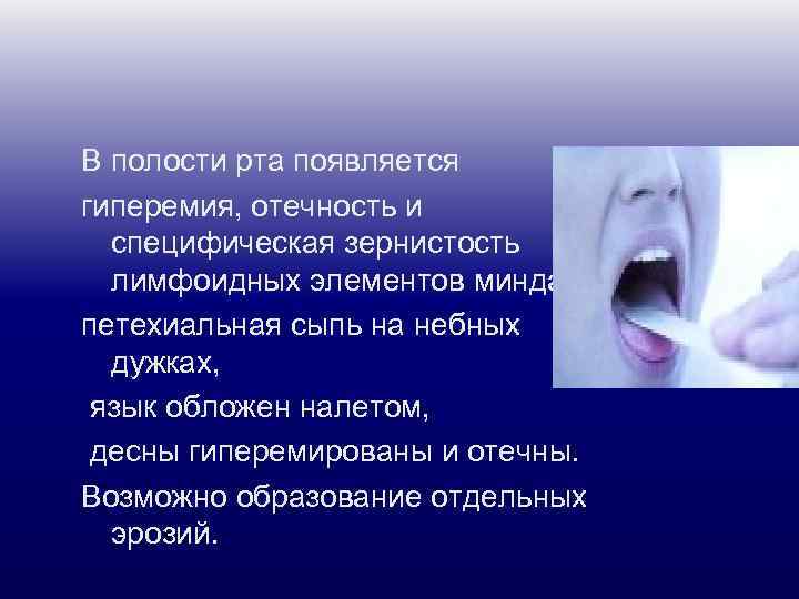 В полости рта появляется гиперемия, отечность и специфическая зернистость лимфоидных элементов миндалин, петехиальная сыпь