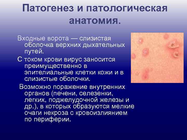 Патогенез и патологическая анатомия. Входные ворота — слизистая оболочка верхних дыхательных путей. С током