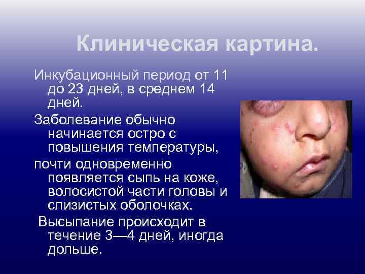 Клиническая картина. Инкубационный период от 11 до 23 дней, в среднем 14 дней. Заболевание