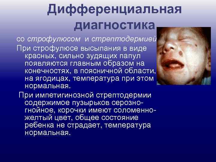Дифференциальная диагностика со строфулюсом и стрептодермией При строфулюсе высыпания в виде красных, сильно зудящих