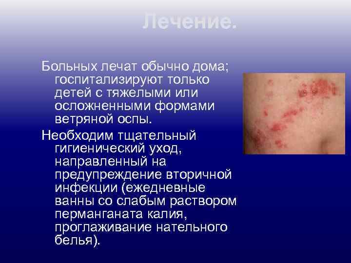 Лечение. Больных лечат обычно дома; госпитализируют только детей с тяжелыми или осложненными формами ветряной