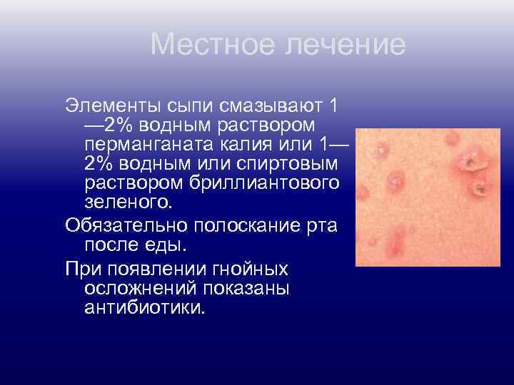 Местное лечение Элементы сыпи смазывают 1 — 2% водным раствором перманганата калия или 1—