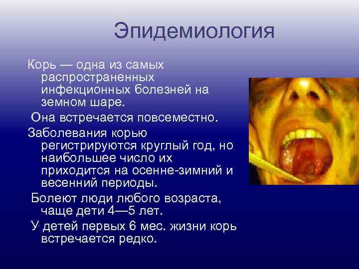 Эпидемиология Корь — одна из самых распространенных инфекционных болезней на земном шаре. Она встречается