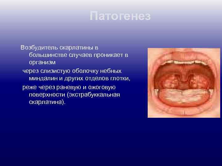 Патогенез Возбудитель скарлатины в большинстве случаев проникает в организм через слизистую оболочку небных миндалин