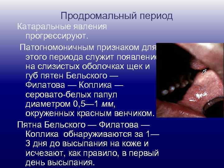 Продромальный период Катаральные явления прогрессируют. Патогномоничным признаком для этого периода служит появление на слизистых
