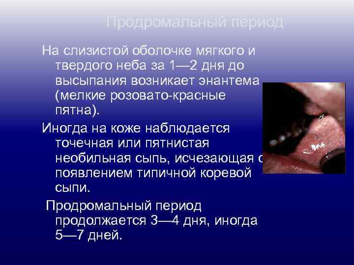 Продромальный период На слизистой оболочке мягкого и твердого неба за 1— 2 дня до