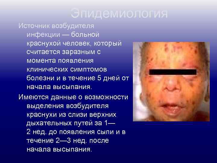 Эпидемиология Источник возбудителя инфекции — больной краснухой человек, который считается заразным с момента появления