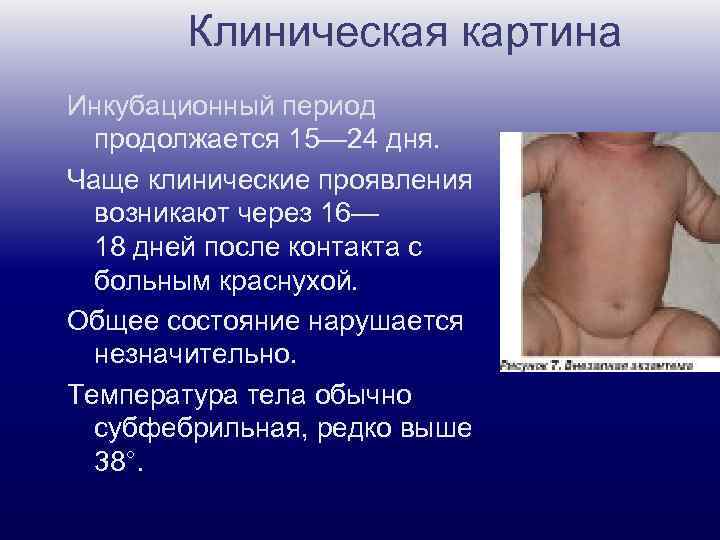 Клиническая картина Инкубационный период продолжается 15— 24 дня. Чаще клинические проявления возникают через 16—
