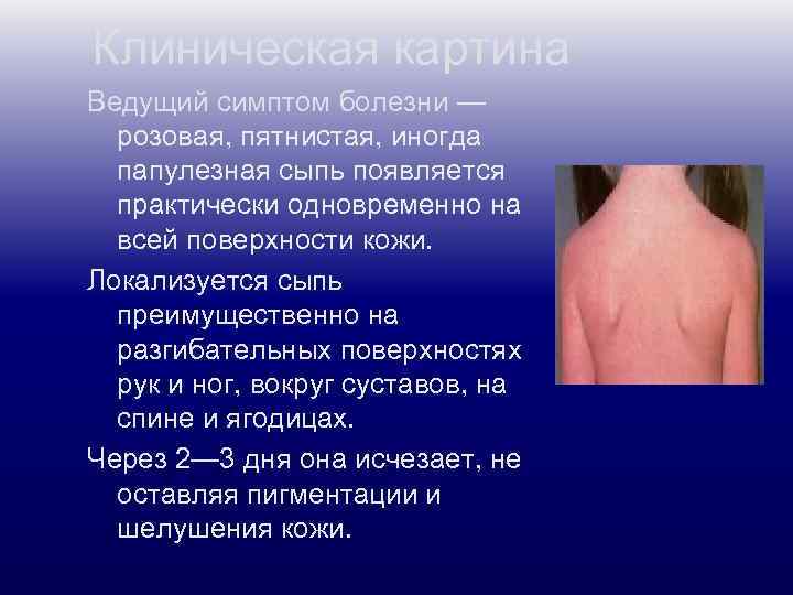 Клиническая картина Ведущий симптом болезни — розовая, пятнистая, иногда папулезная сыпь появляется практически одновременно
