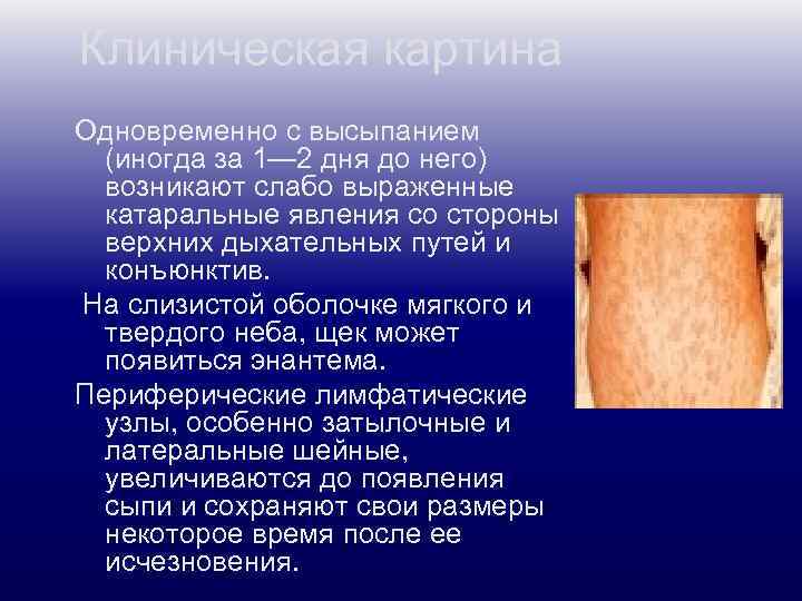 Клиническая картина Одновременно с высыпанием (иногда за 1— 2 дня до него) возникают слабо
