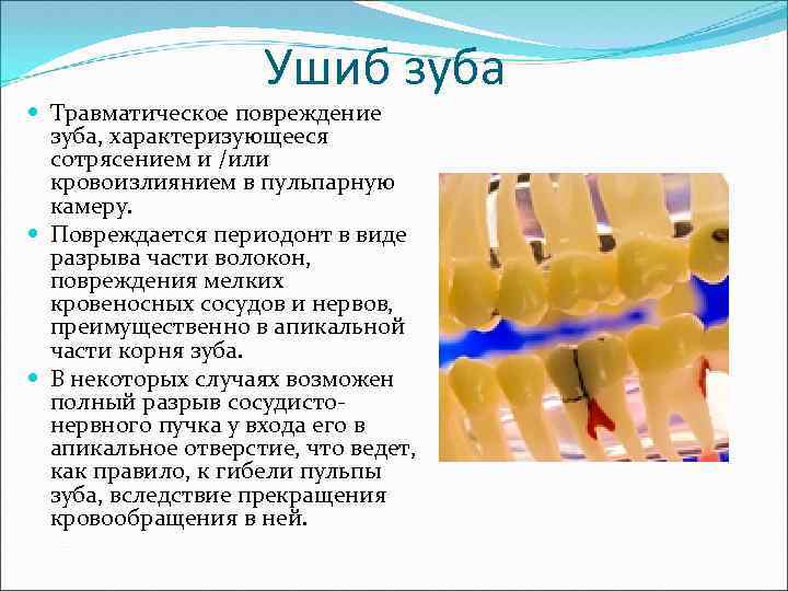 Ушиб зуба Травматическое повреждение зуба, характеризующееся сотрясением и /или кровоизлиянием в пульпарную камеру. Повреждается