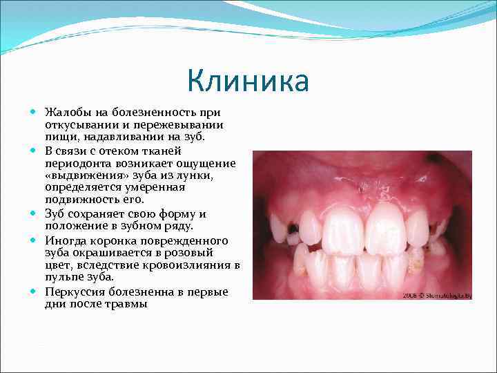 Клиника Жалобы на болезненность при откусывании и пережевывании пищи, надавливании на зуб. В связи