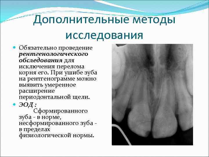 Дополнительные методы исследования Обязательно проведение рентгенологического обследования для исключения перелома корня его. При ушибе