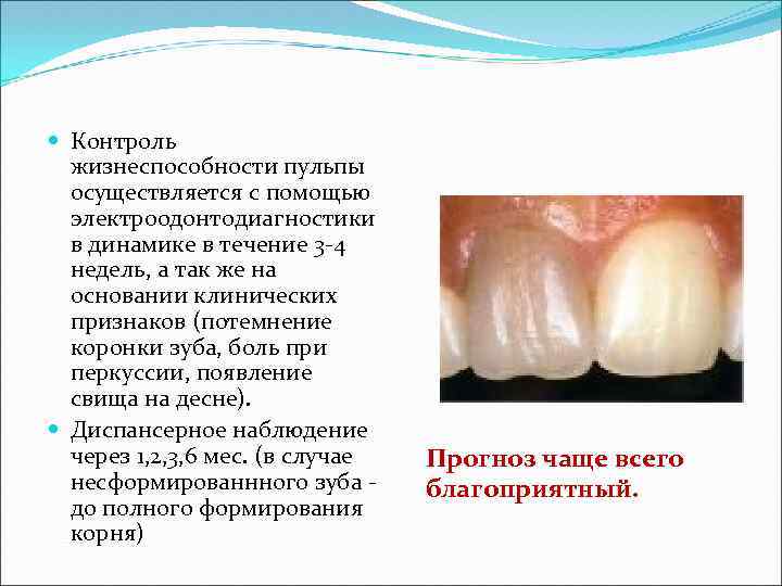  Контроль жизнеспособности пульпы осуществляется с помощью электроодонтодиагностики в динамике в течение 3 -4
