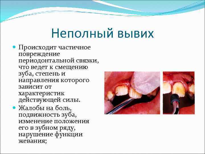 Неполный вывих Происходит частичное повреждение периодонтальной связки, что ведет к смещению зуба, степень и